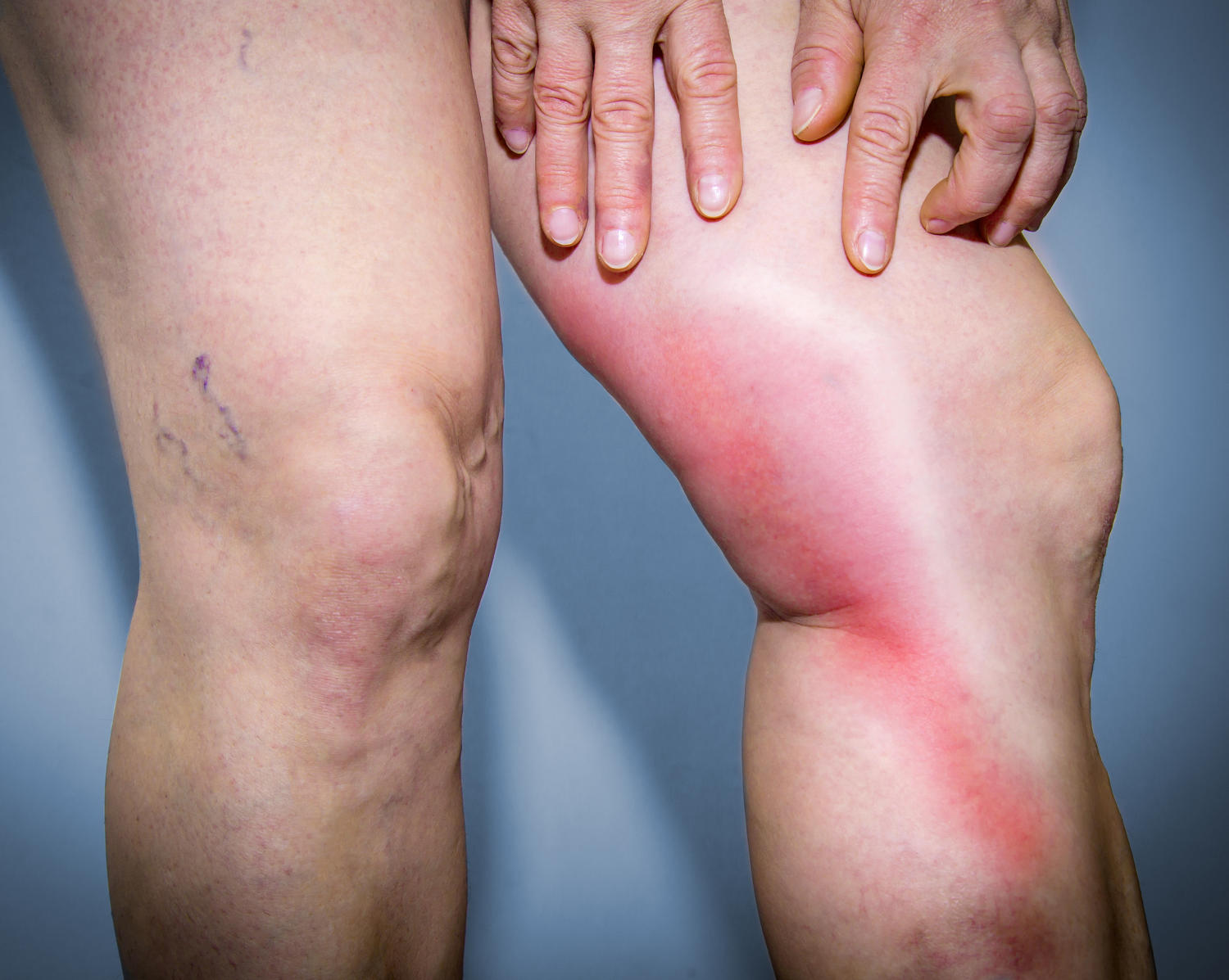 Tromboflebite su una gamba