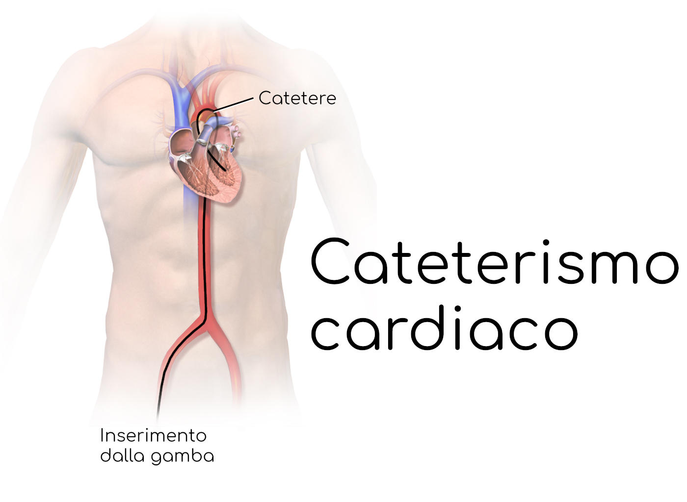 Cateterismo cardiaco