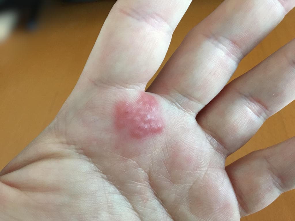 Dermatite da contatto su una mano