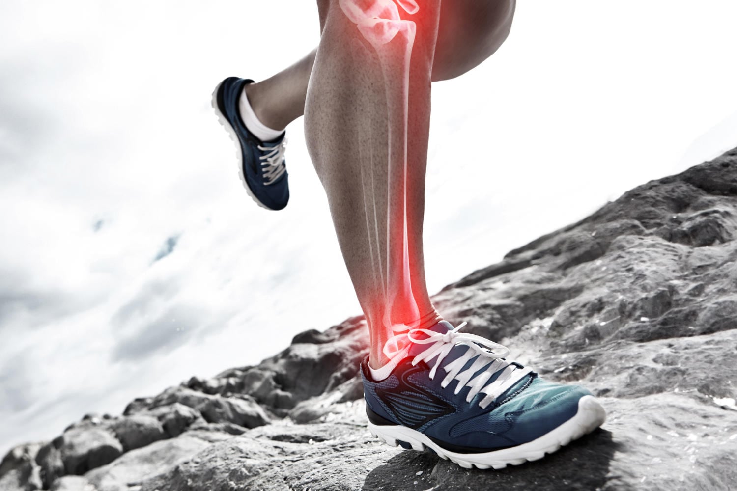 Shin Splints (sindrome da stress tibiale mediale)