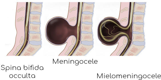 Forme di spina bifida