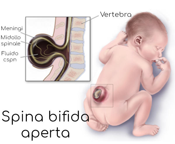 Spina bifida