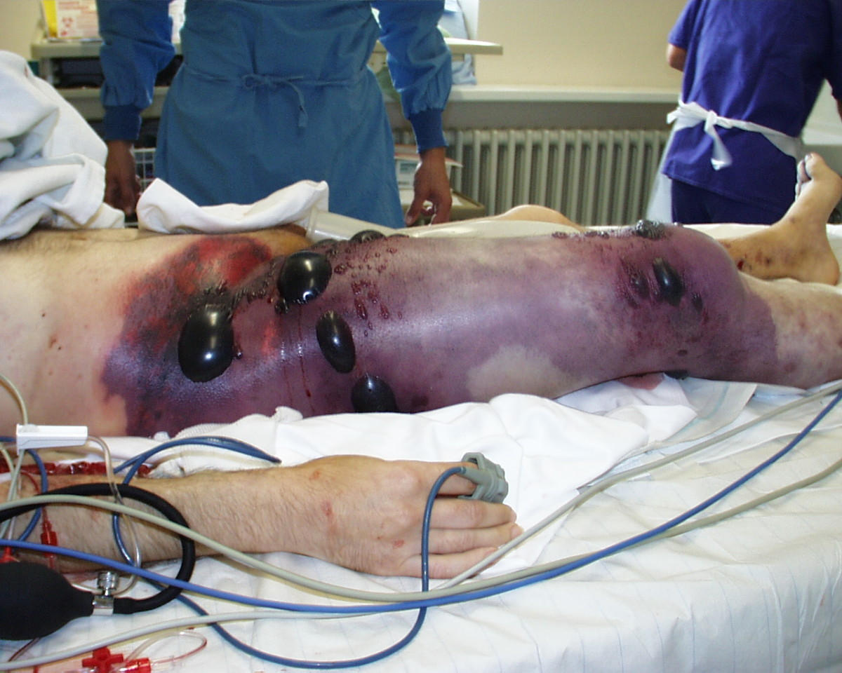 Gangrena gassosa sulla gamba