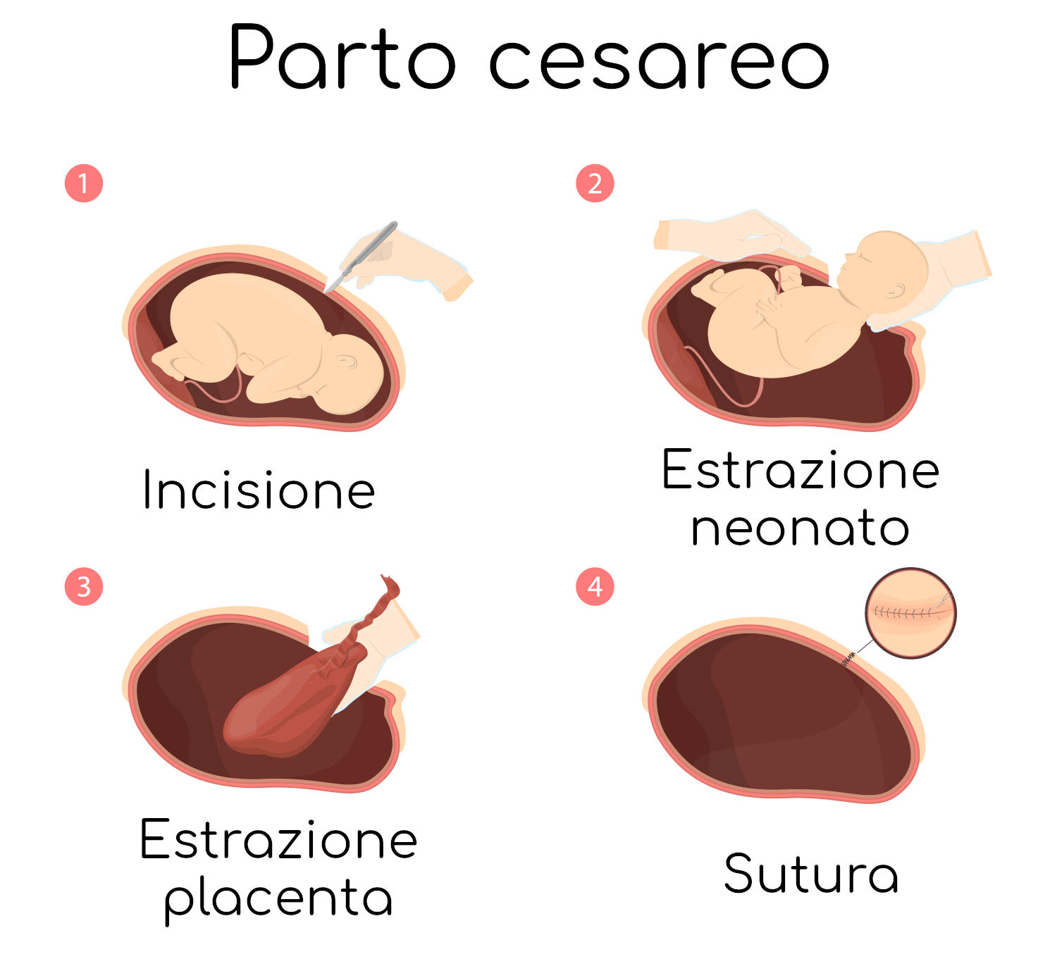 Parto cesareo