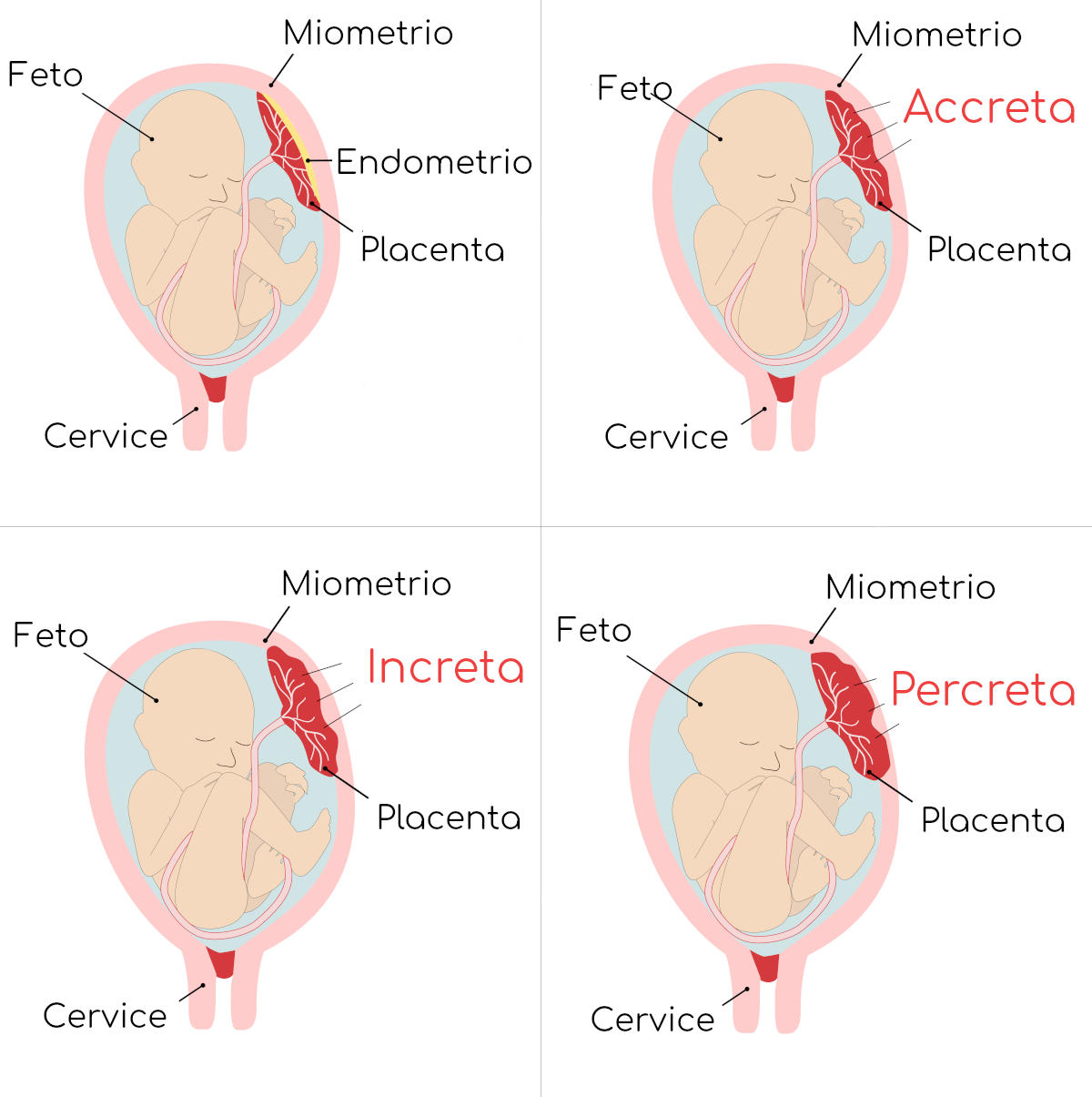 Placenta accreta