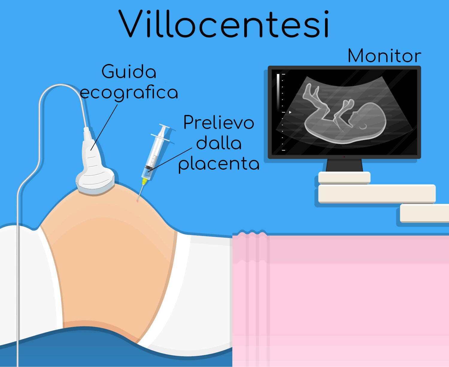 Villocentesi