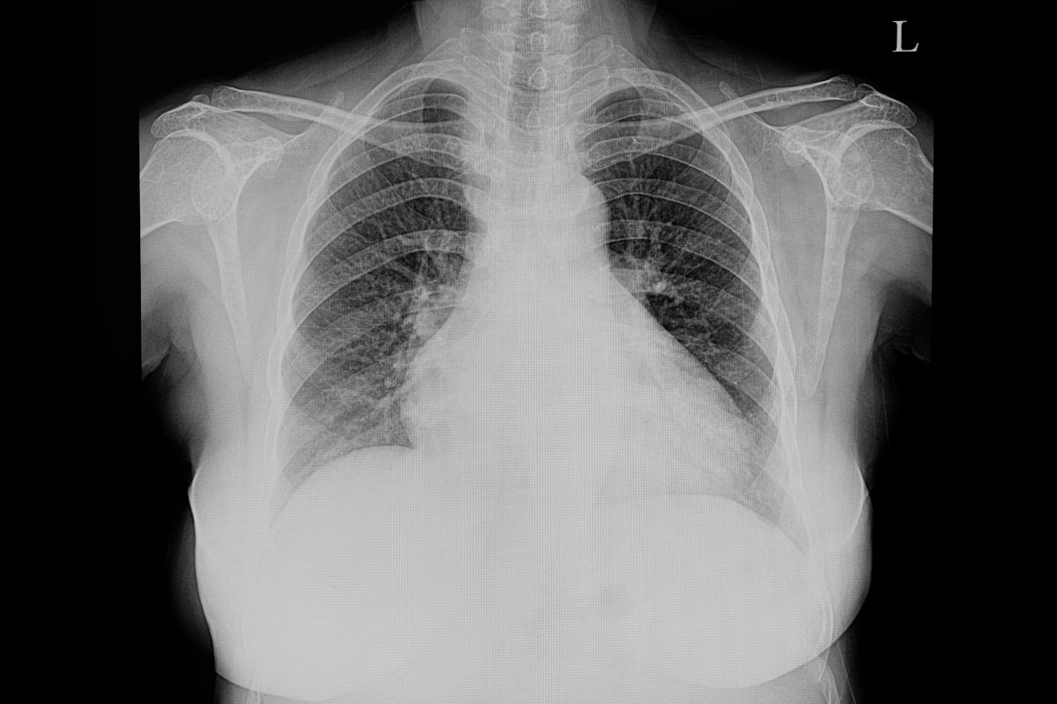 Cuore ingrossato visto ad una radiografia del torace