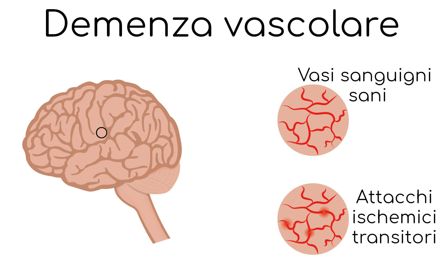 Demenza vascolare