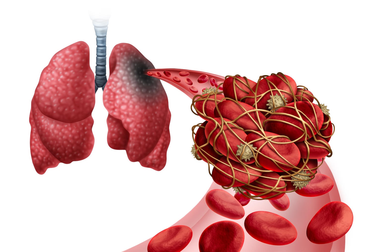 Embolia ed infarto polmonare