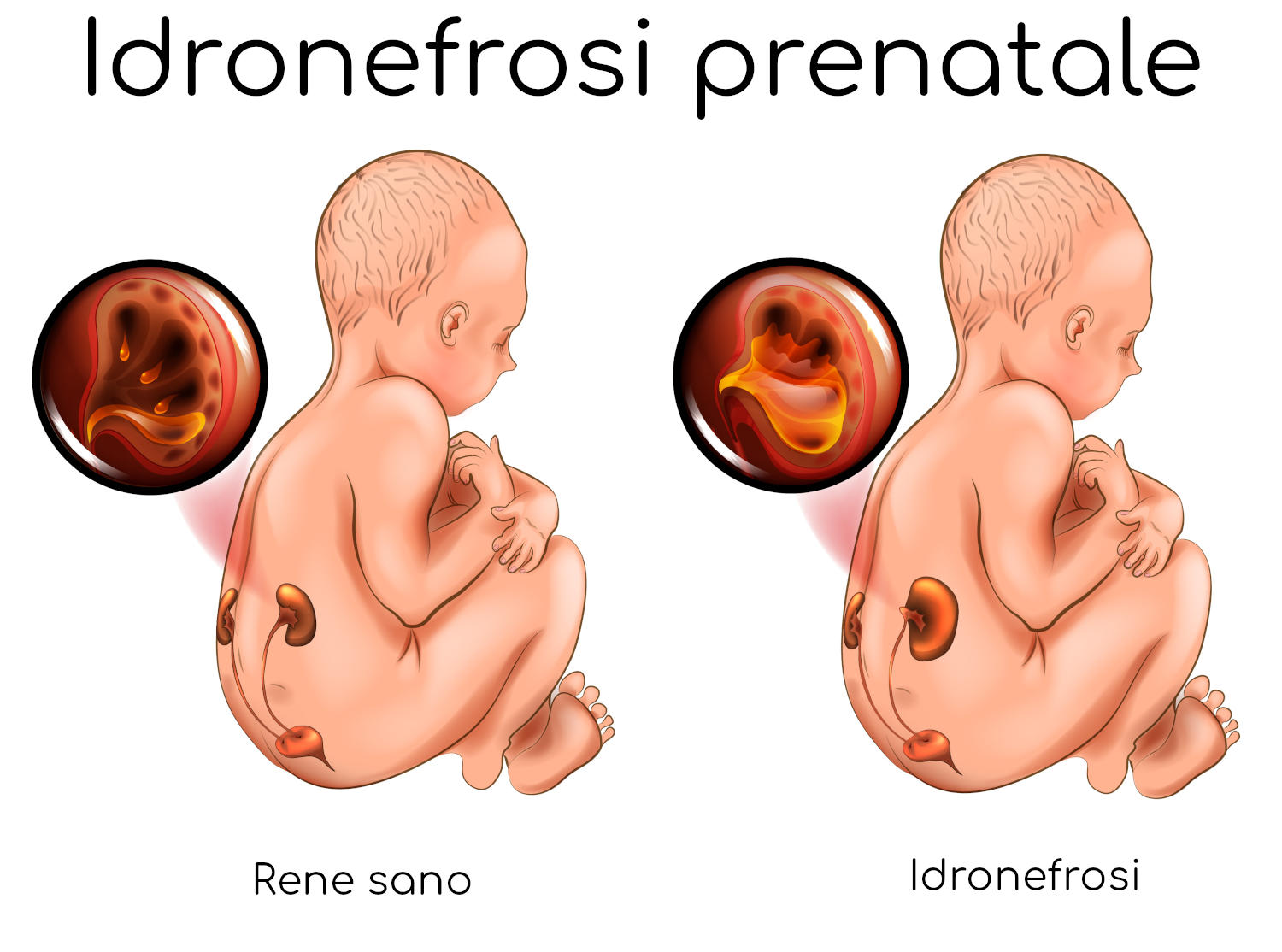 Idronefrosi prenatale