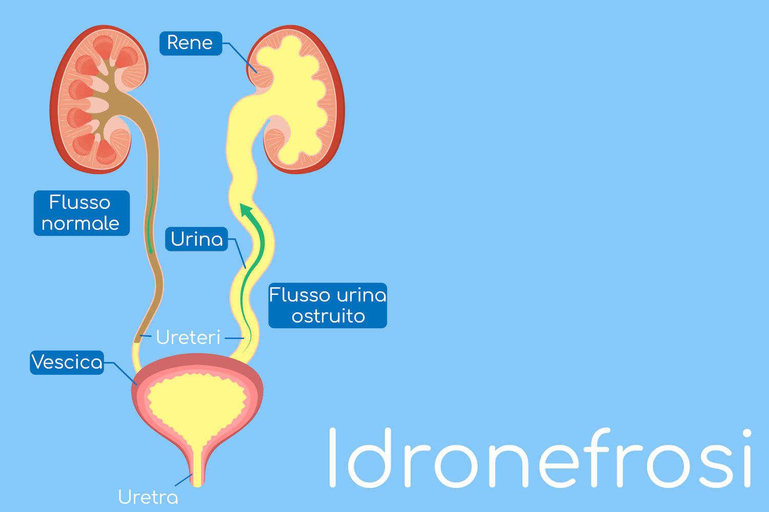 Idronefrosi