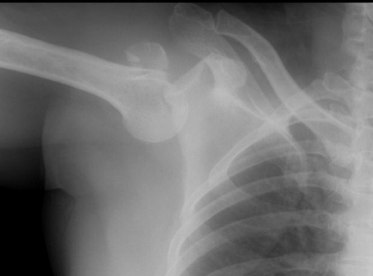 Radiografia di una lussazione alla spalla
