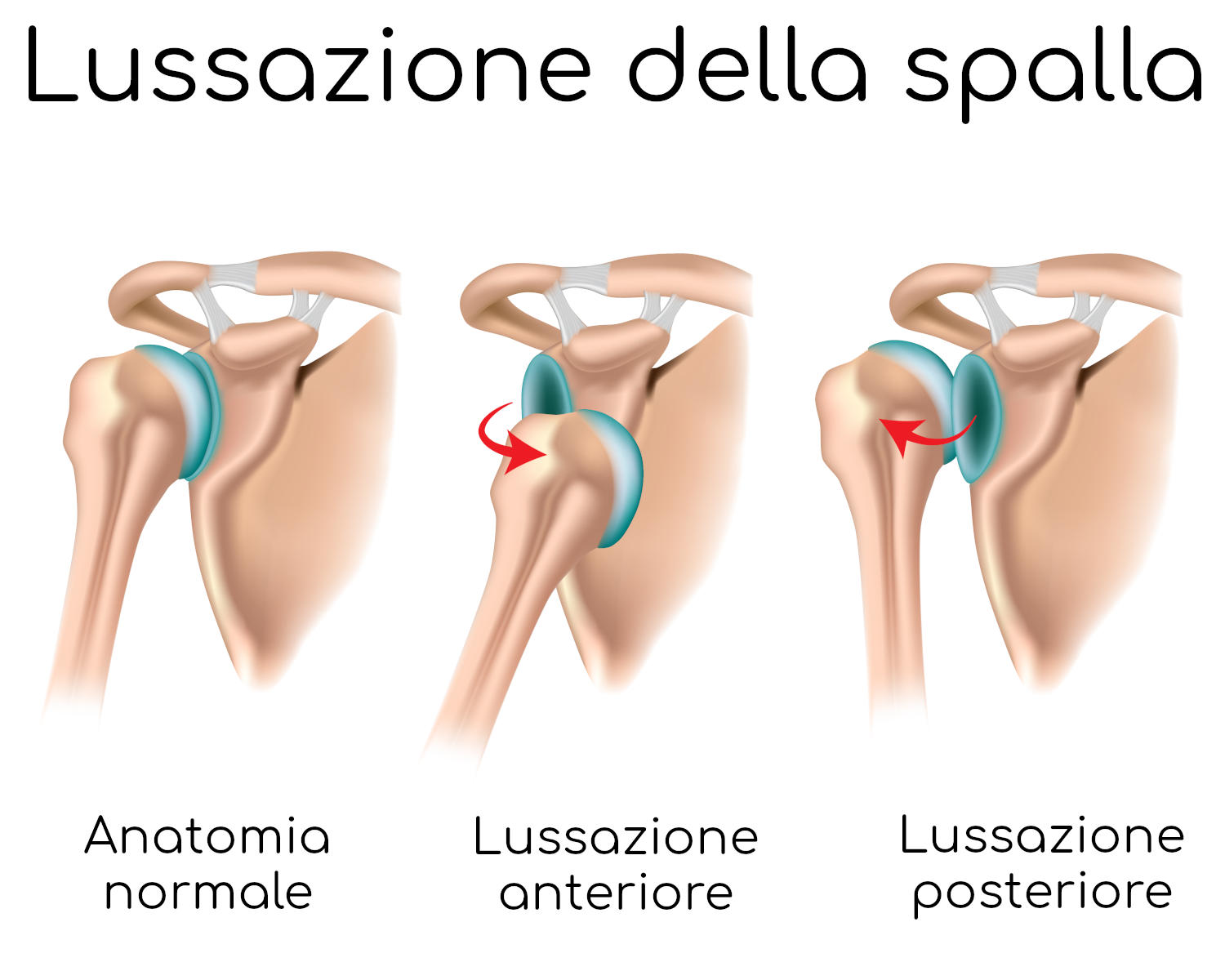 Lussazione della spalla