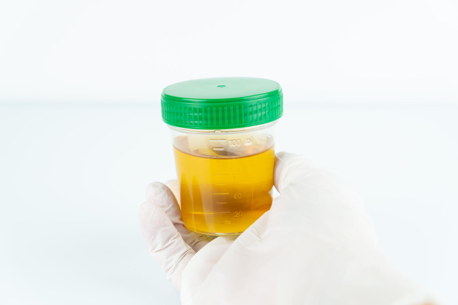 Esame delle proteine nelle urine