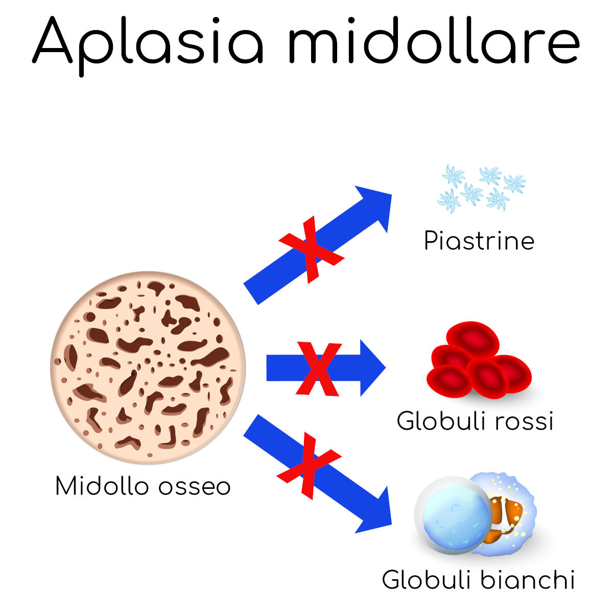 Aplasia midollare