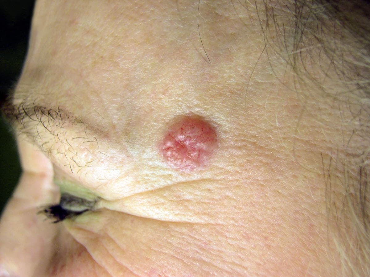 Carcinoma basocellulare sul viso