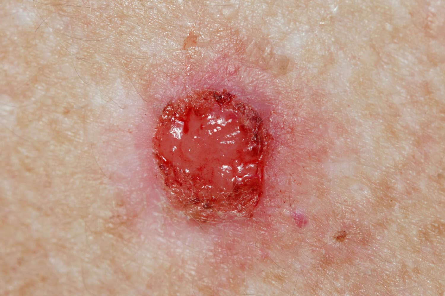 Carcinoma basocellulare