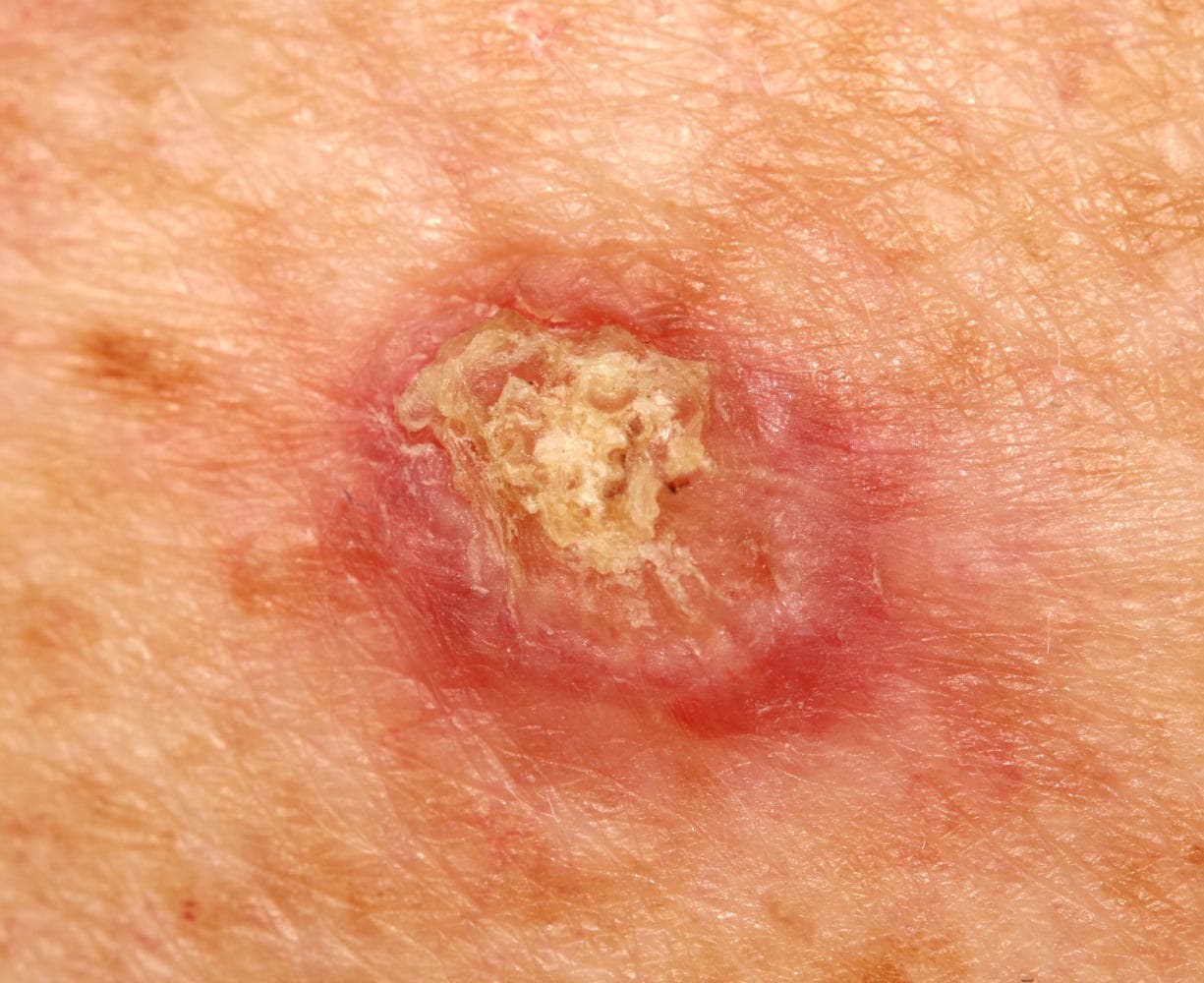 Carcinoma squamocellulare