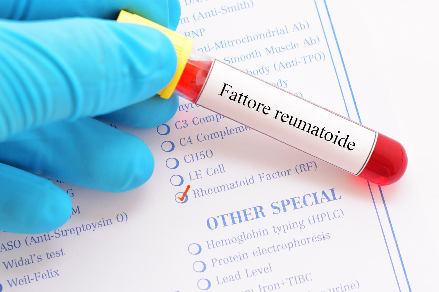 Fattore reumatoide
