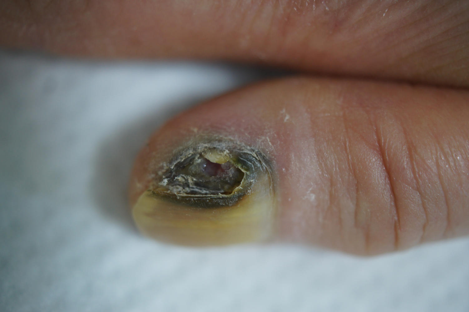 Melanoma subungueale in fase avanzata