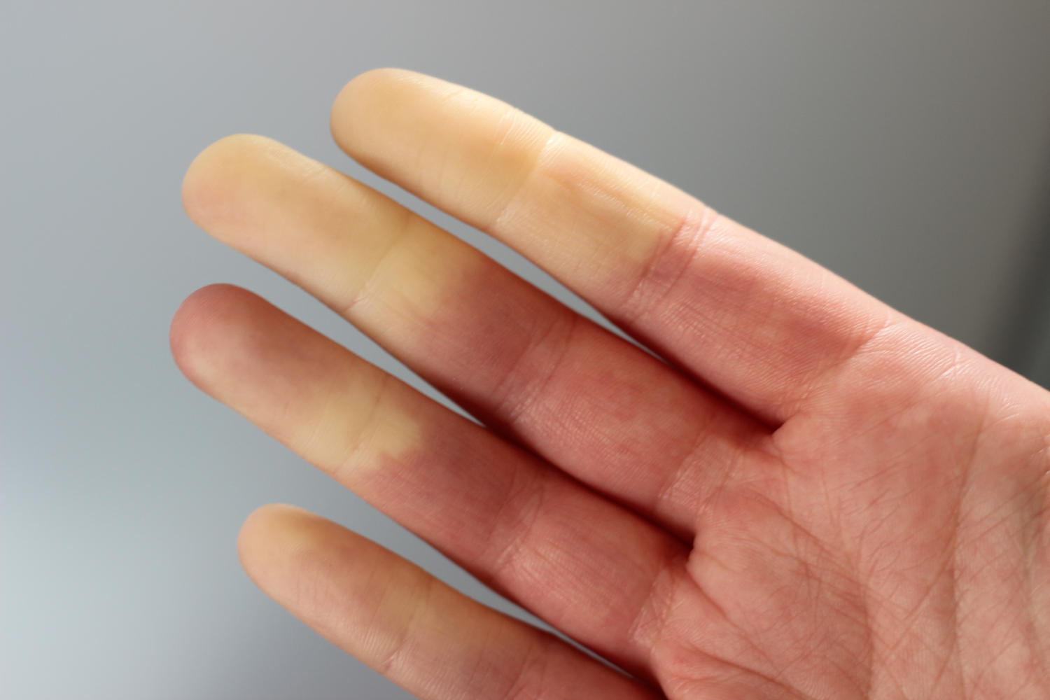 Fenomeno di Raynaud
