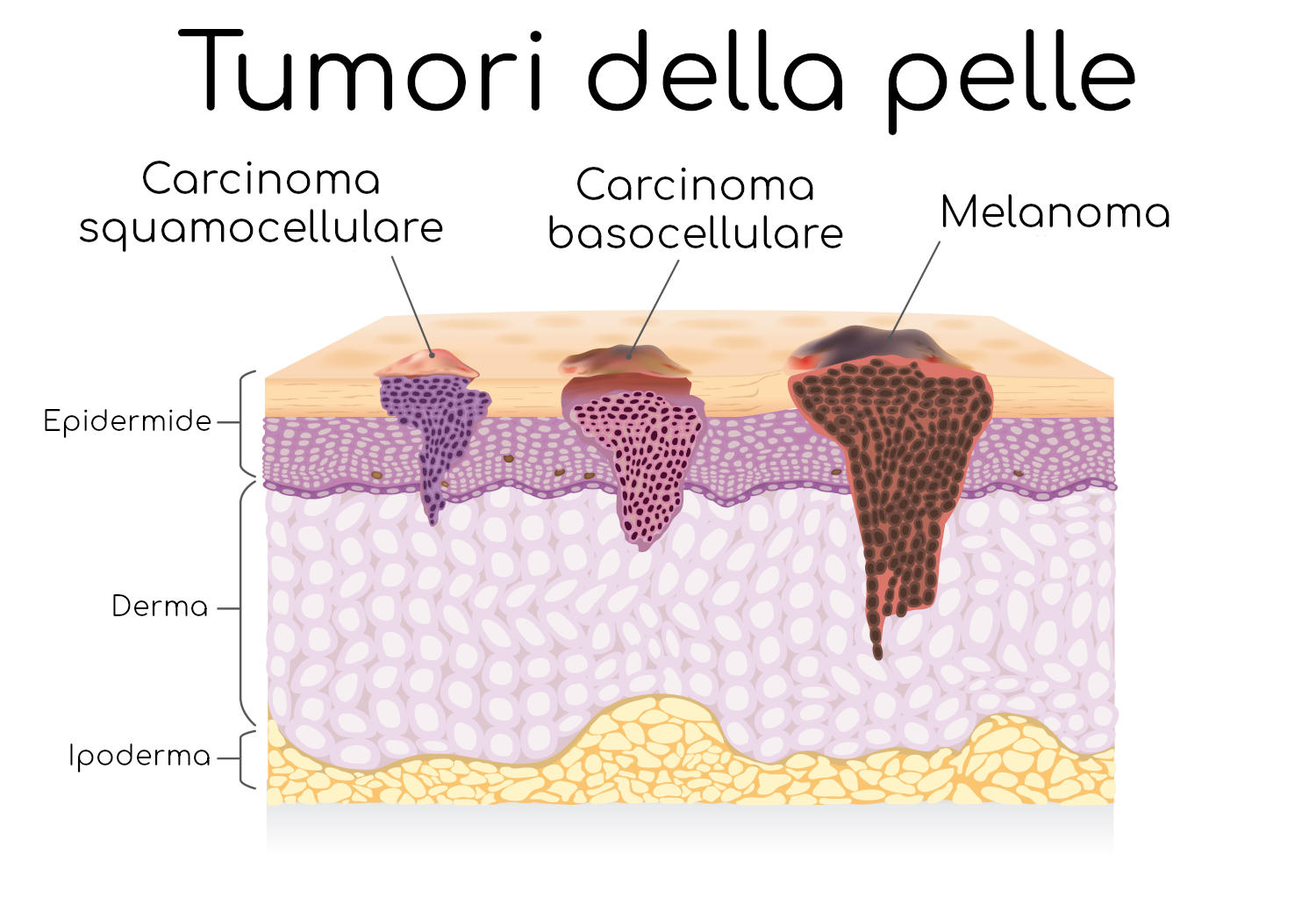 Tumori della pelle