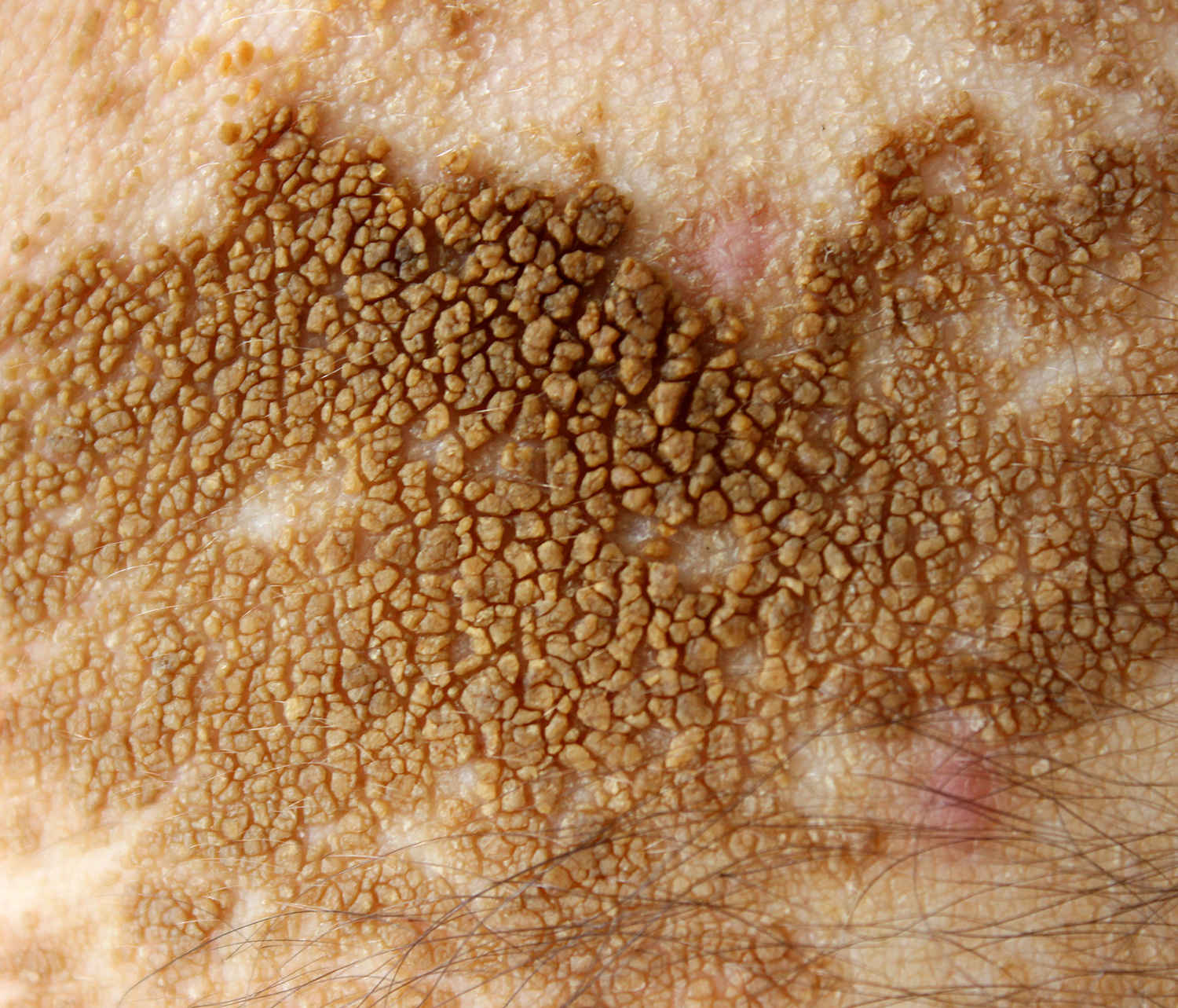 Sindrome del nevo epidermico