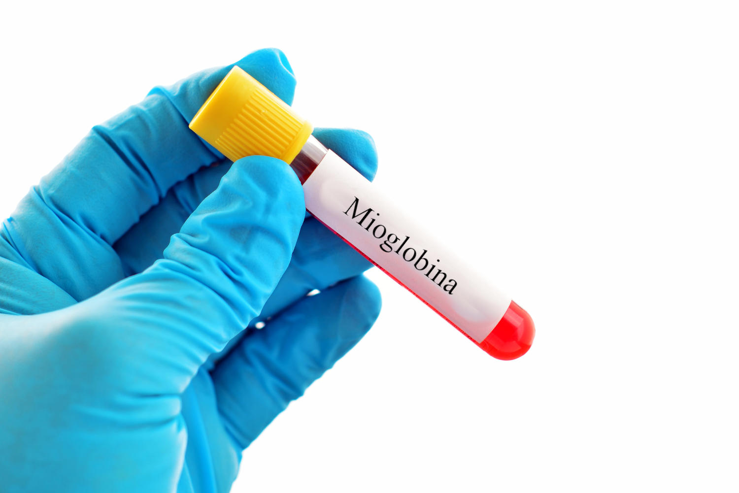 Provetta di sangue con la scritta mioglobina