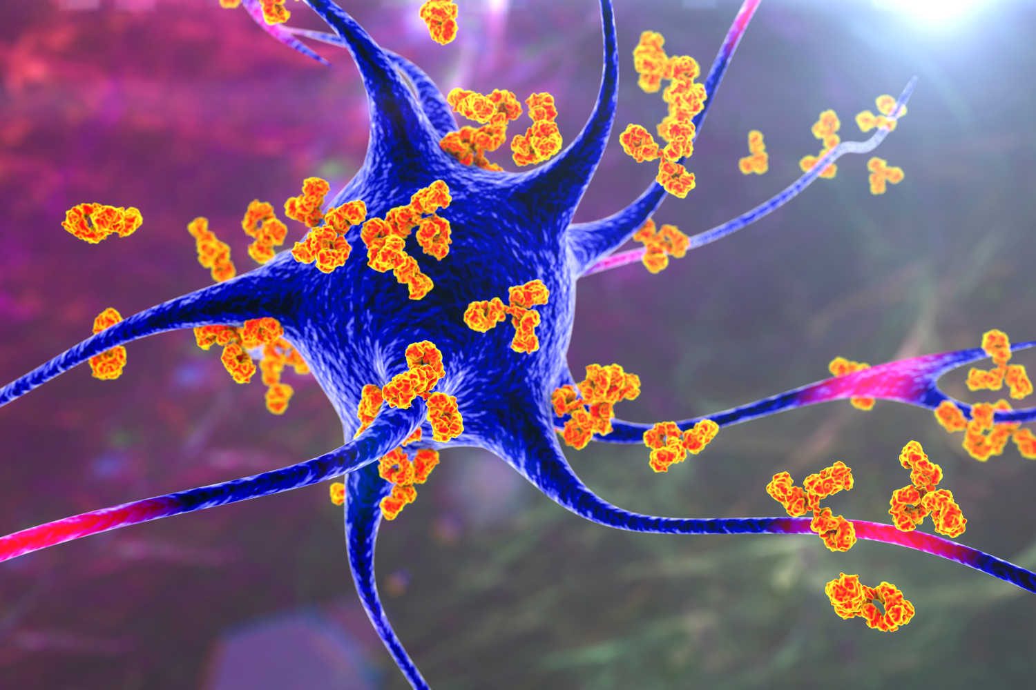 Autoanticorpi che attaccano cellule nervose nella sindrome paraneoplastica