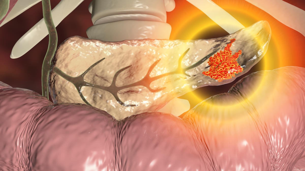 Tumore al pancreas