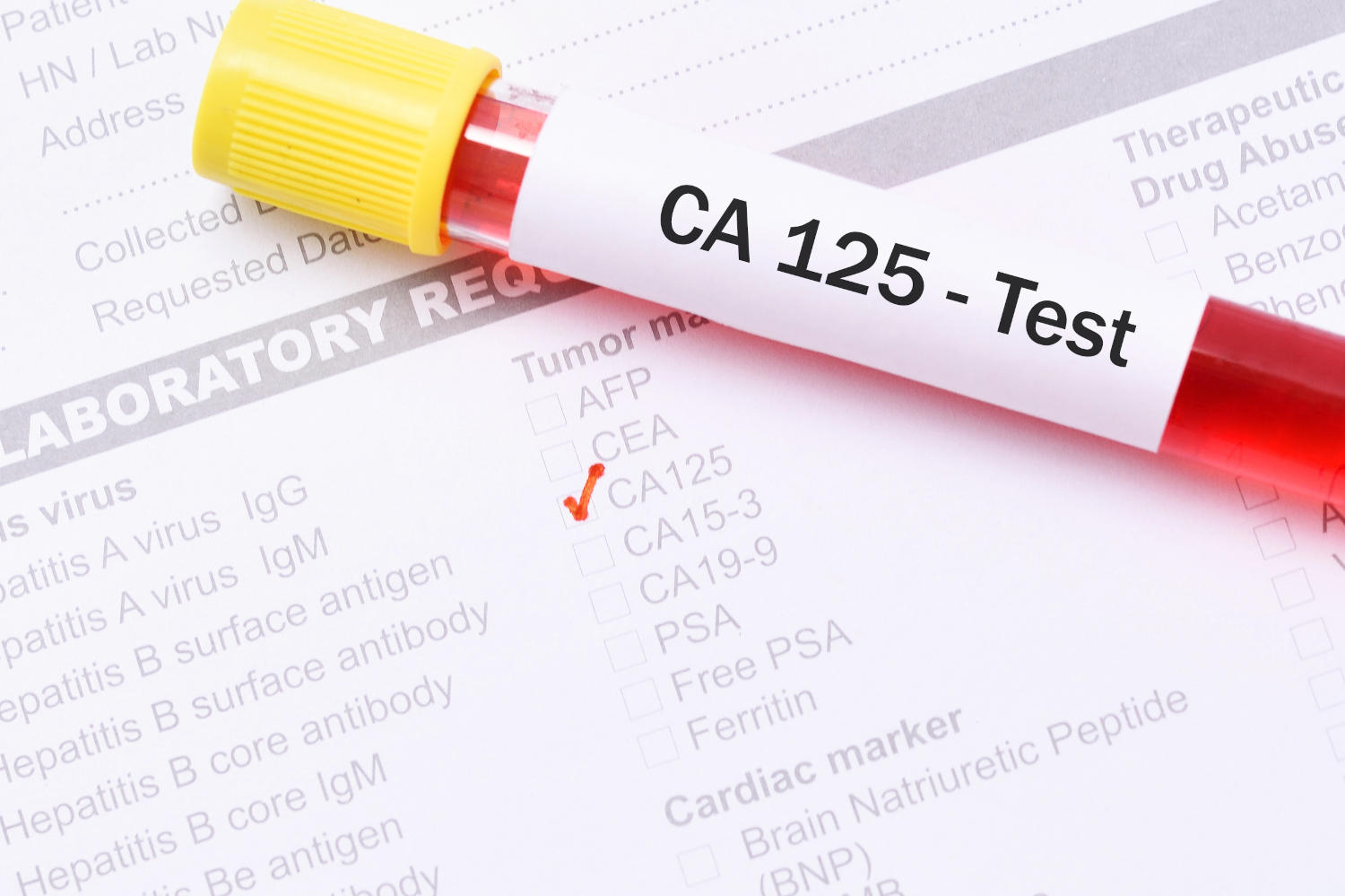 Esame del sangue del CA-125