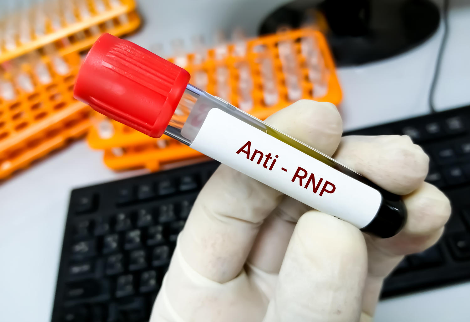 Anticorpi anti-rnp