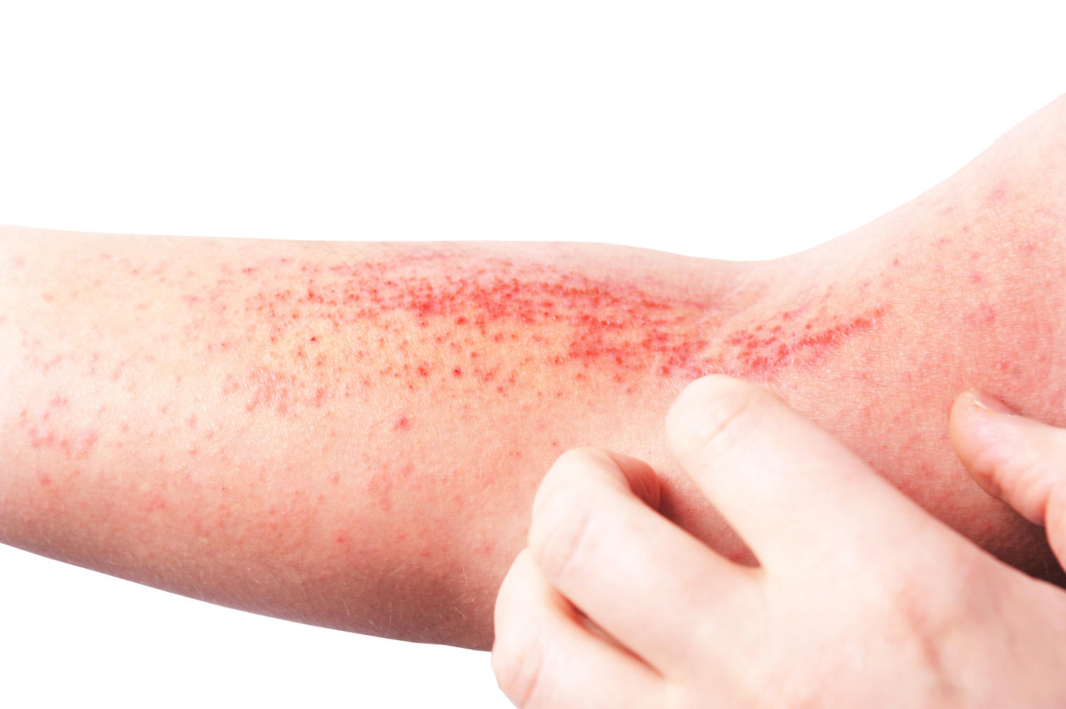 Dermatite da stress sul braccio
