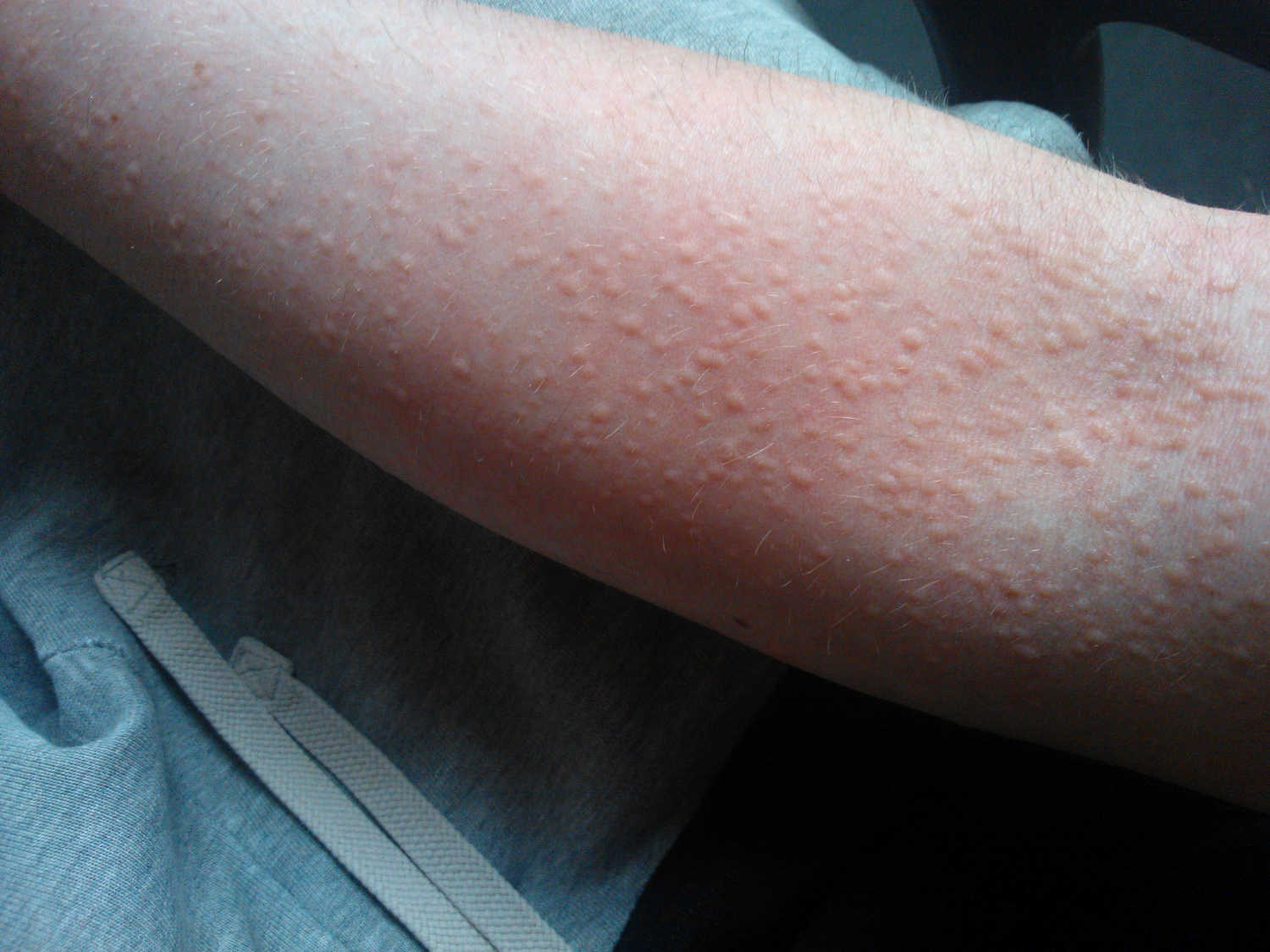 Orticaria colinergica su di un braccio
