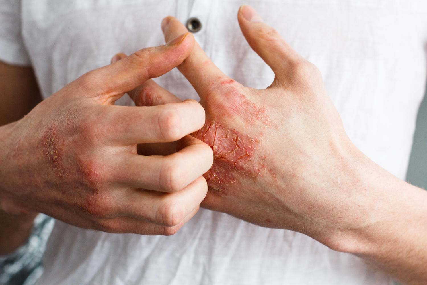 Orticaria da stress sulla mano