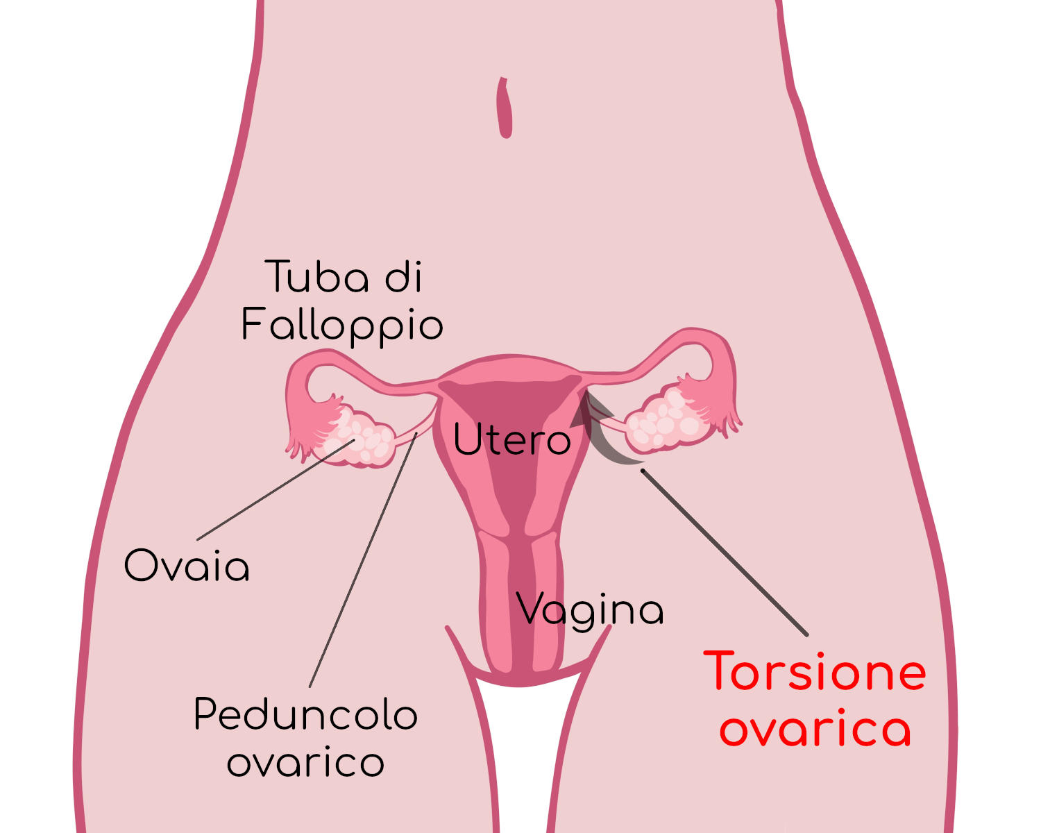 Torsione ovarica