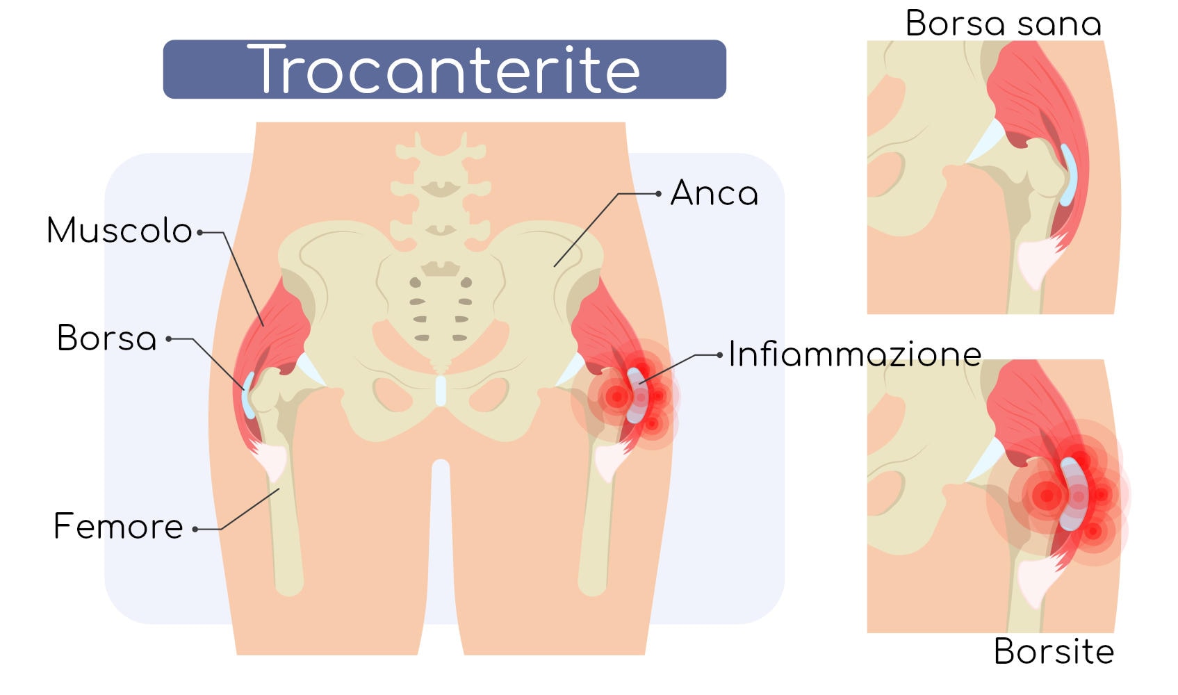Trocanterite
