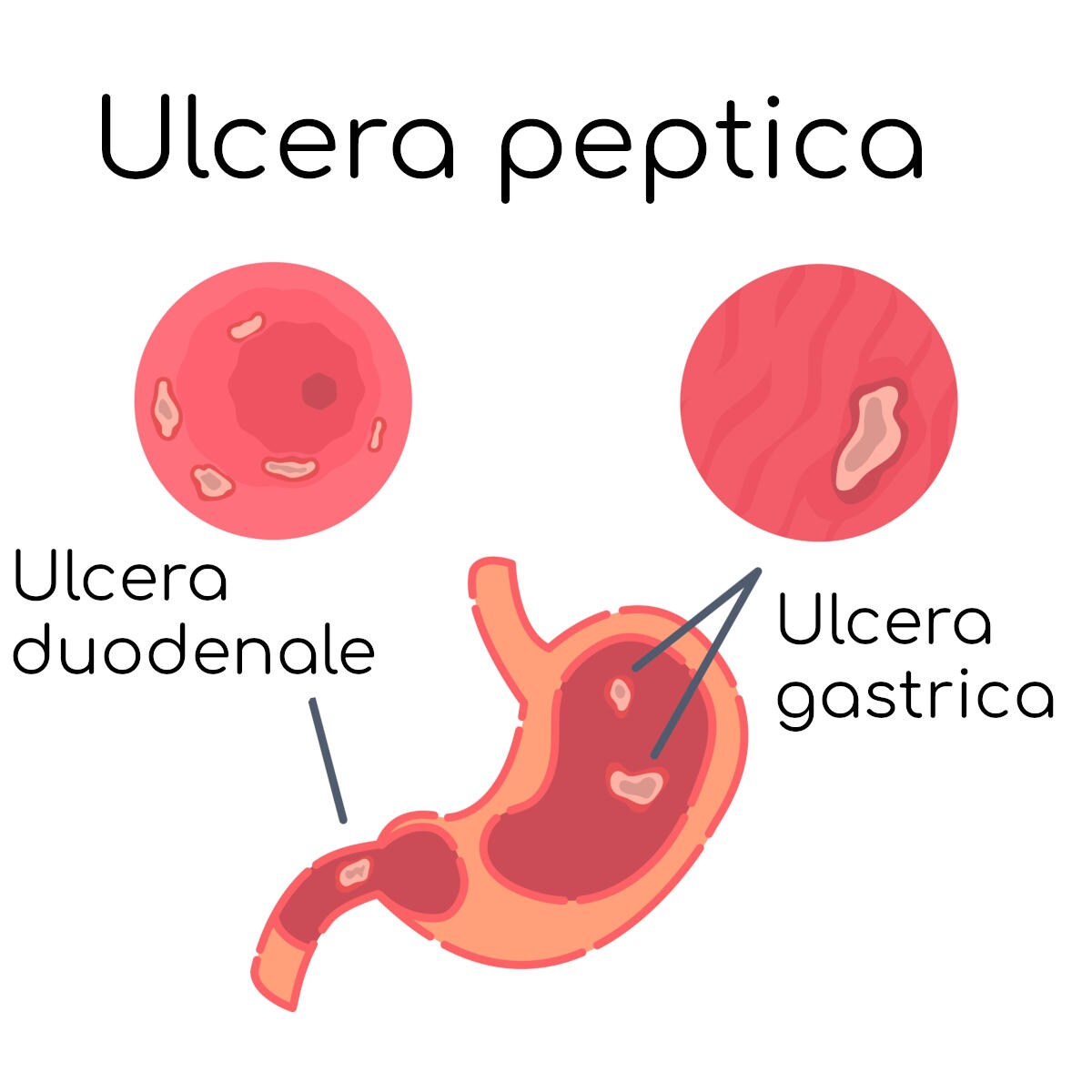 Ulcera peptica