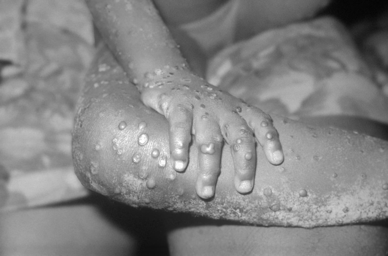 Vaiolo delle scimmie, eruzione cutanea