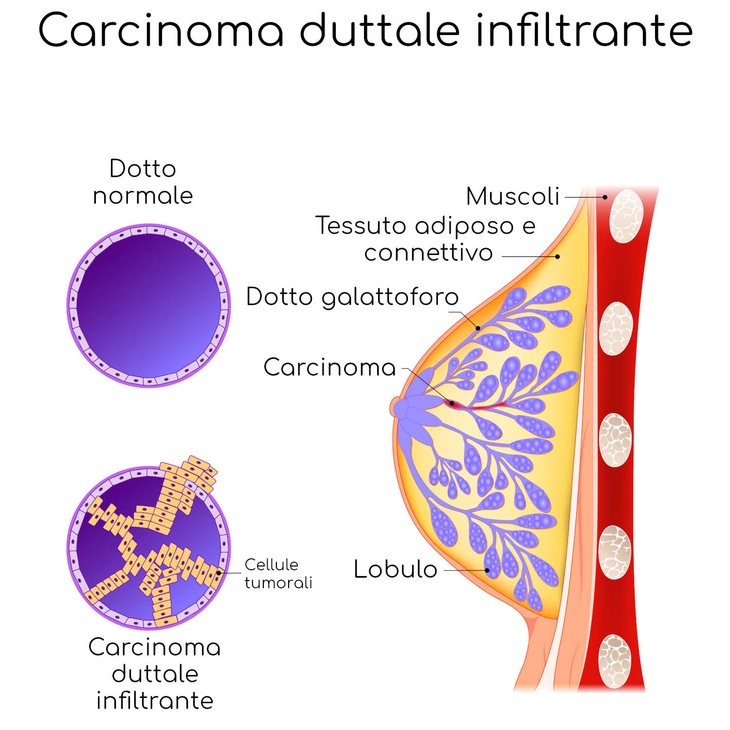 Carcinoma duttale infiltrante