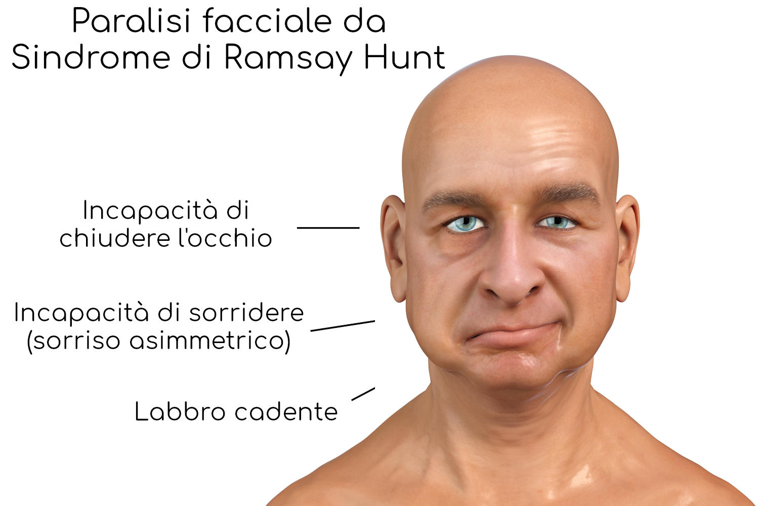 Paralisi facciale da sindrome di RamsayHunt