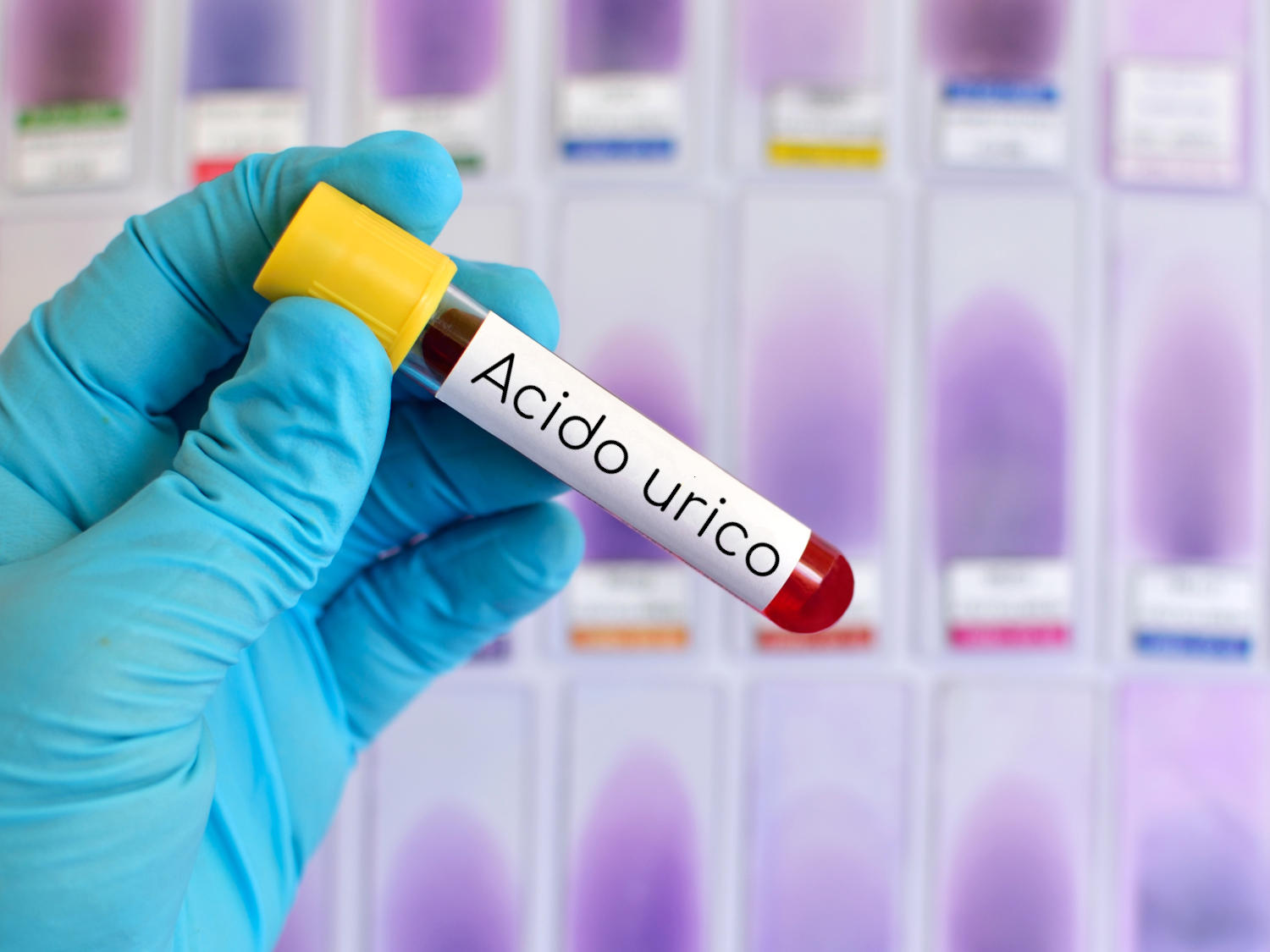 Acido urico, provetta di sangue
