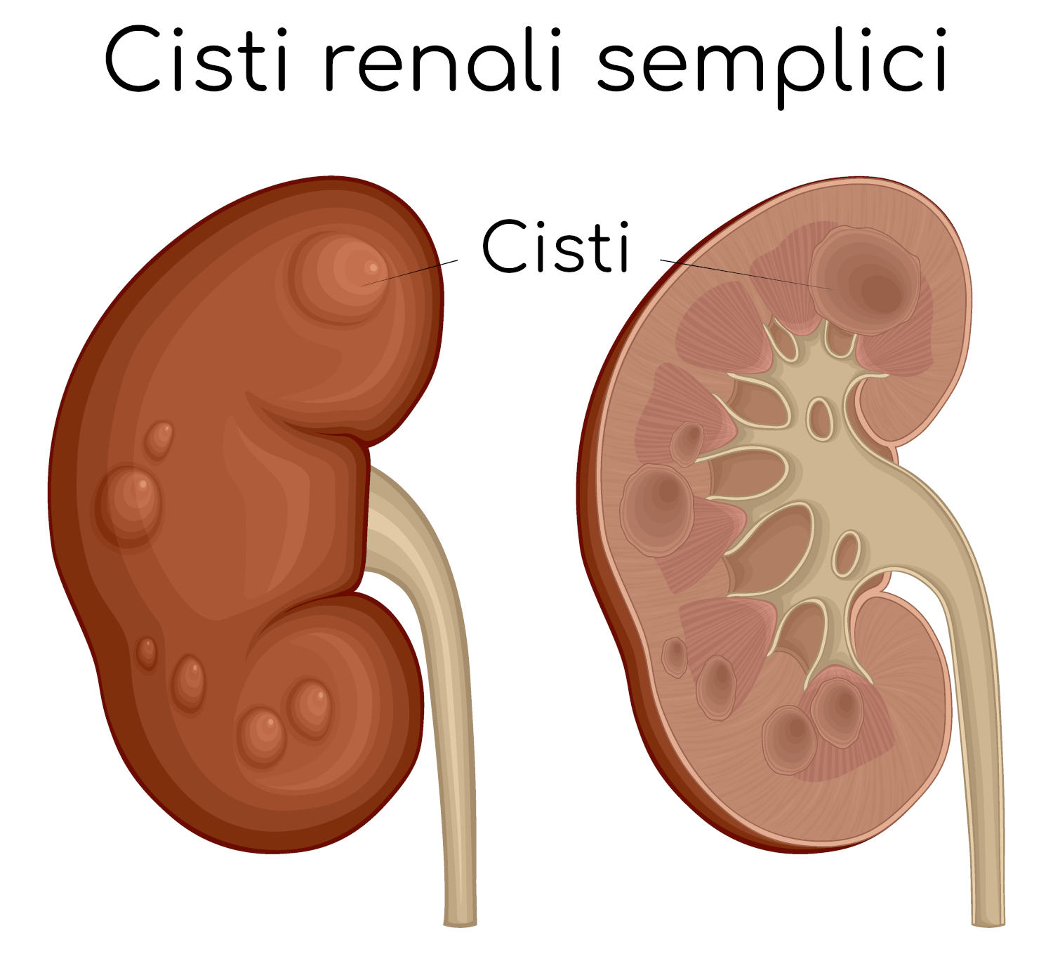Cisti renali