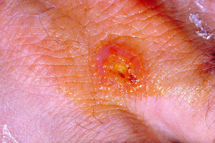 Ulcerazione da tularemia