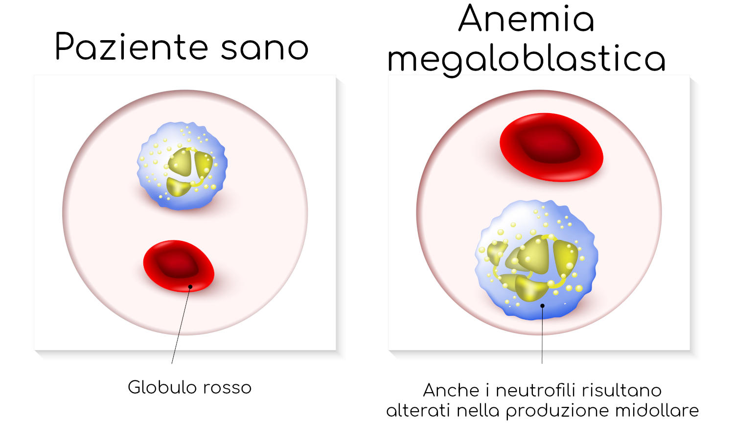 Anemia megaloblastica