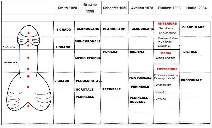 Ipospadia, classificazione