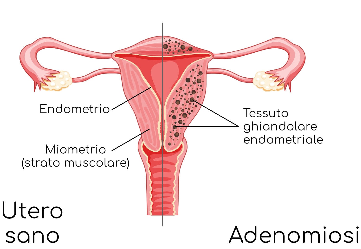 Adenomiosi