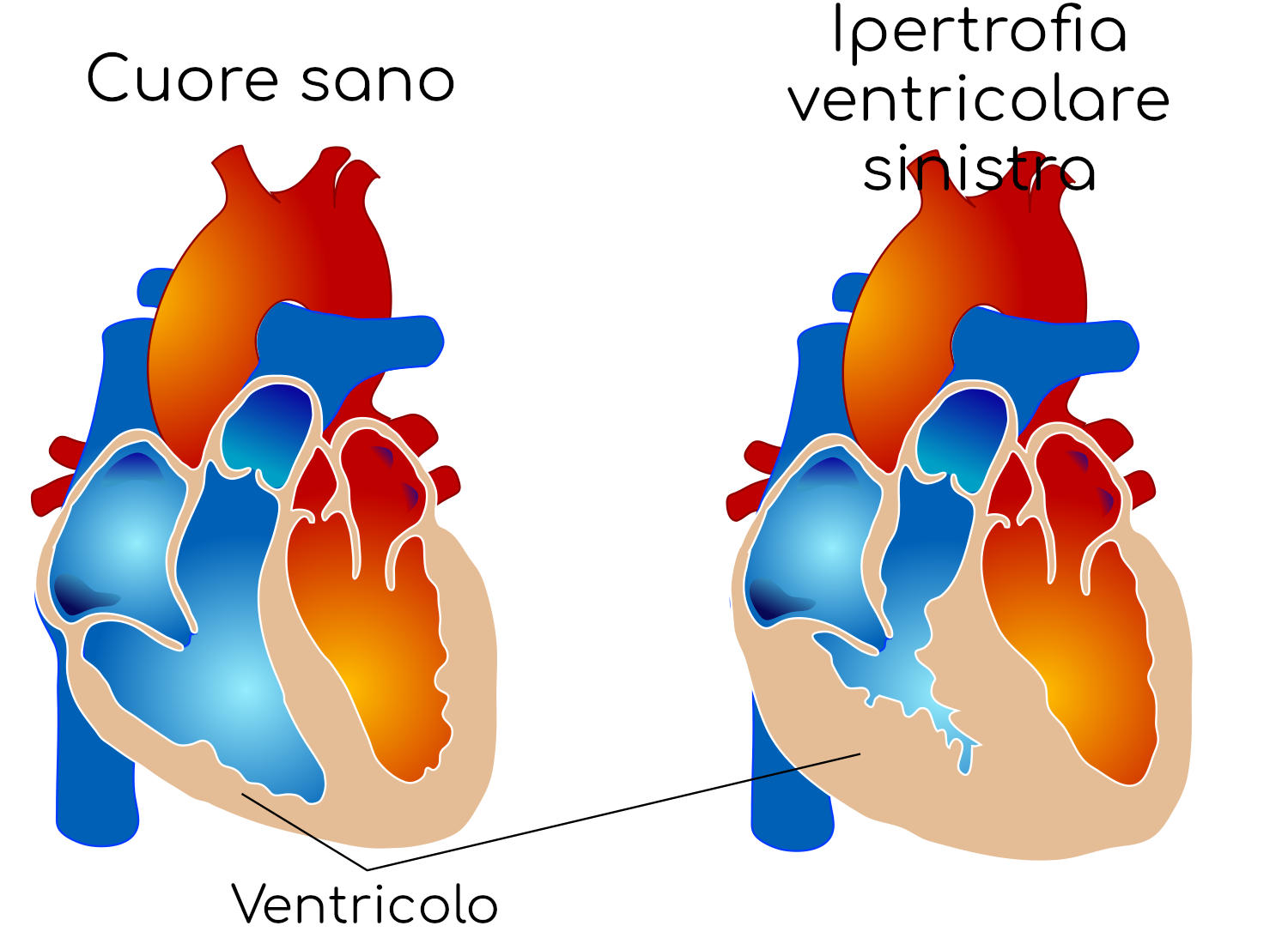 Ipertrofia ventricolare