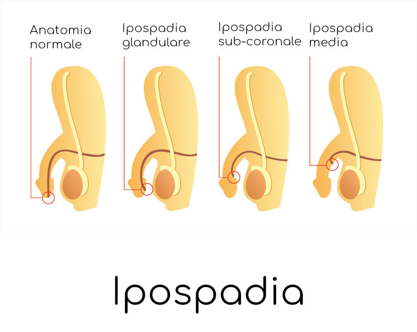 Ipospadia