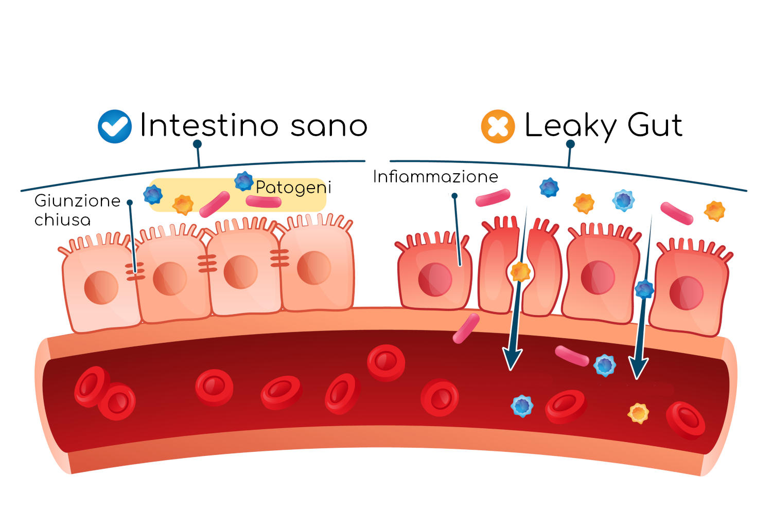 Leaky Gut Syndrome